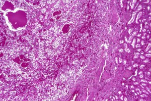 carcinoma lungs renal physicians physician hematuria tomography computed consulted