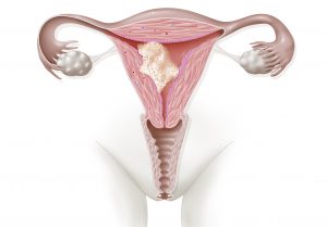 Endometrial cancer, drawing