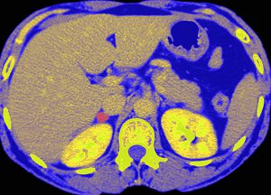 Maladie de Conn. Petit adénome corticosurrénalien situé au dessus du rein droit (rouge). TDM colorisée avec injection intraveineuse d’iode de l’abdomen chez une patiente de 48 ans, coupe axiale.  Primary hyperaldosteronism (Conn