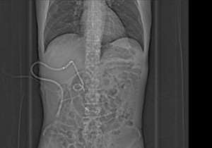 FIGURE 1. Abdominal radiograph; percutaneous biliary drain