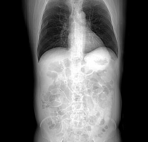 FIGURE 2. Abdominal radiograph; internal biliary stents