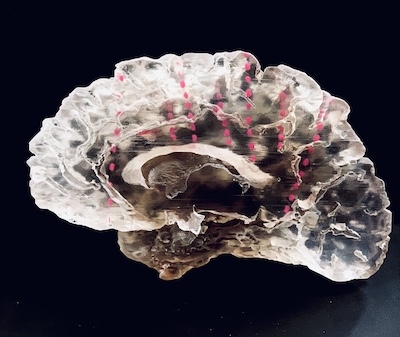 An image of a patient’s brain showing implanted electrodes (in pink)