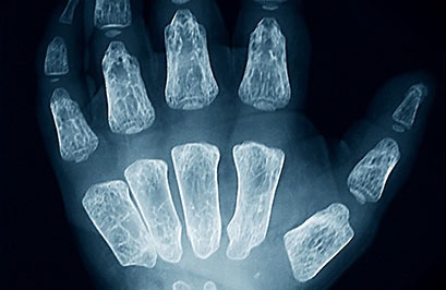 Hurler syndrome. Colored X-ray of the hand of a 28 month old child with Hurler syndrome (also called mucopolysaccharidosis type I, MPS I). This is a rare inherited disorder that affects 1 in 115,000 people. Hurler syndrome is caused by a defective enzyme that is unable to break down glycosaminoglycans (mucopolysaccharides). Glycosaminoglycans are large molecules normally found in the fluid lubricating the joints. If they are not broken down by the enzyme when entering the cells, they cause permanent cell damage that progressively hinders physical development, organ functioning and causes mental retardation. There is no known cure and individuals rarely live past the age of 10 years old.