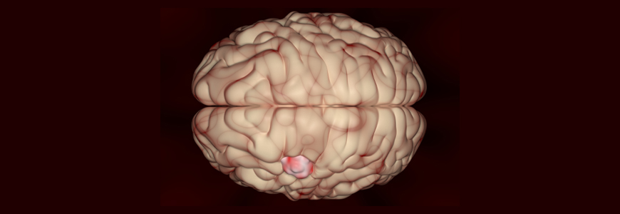 Meningioma (brain cancer) tumor in the brain tissue - 3d illustration top view