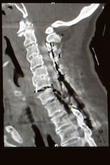 Repaired spinal cord