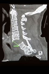 Severed spinal cord