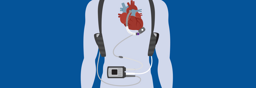 Illustration of a LVAD