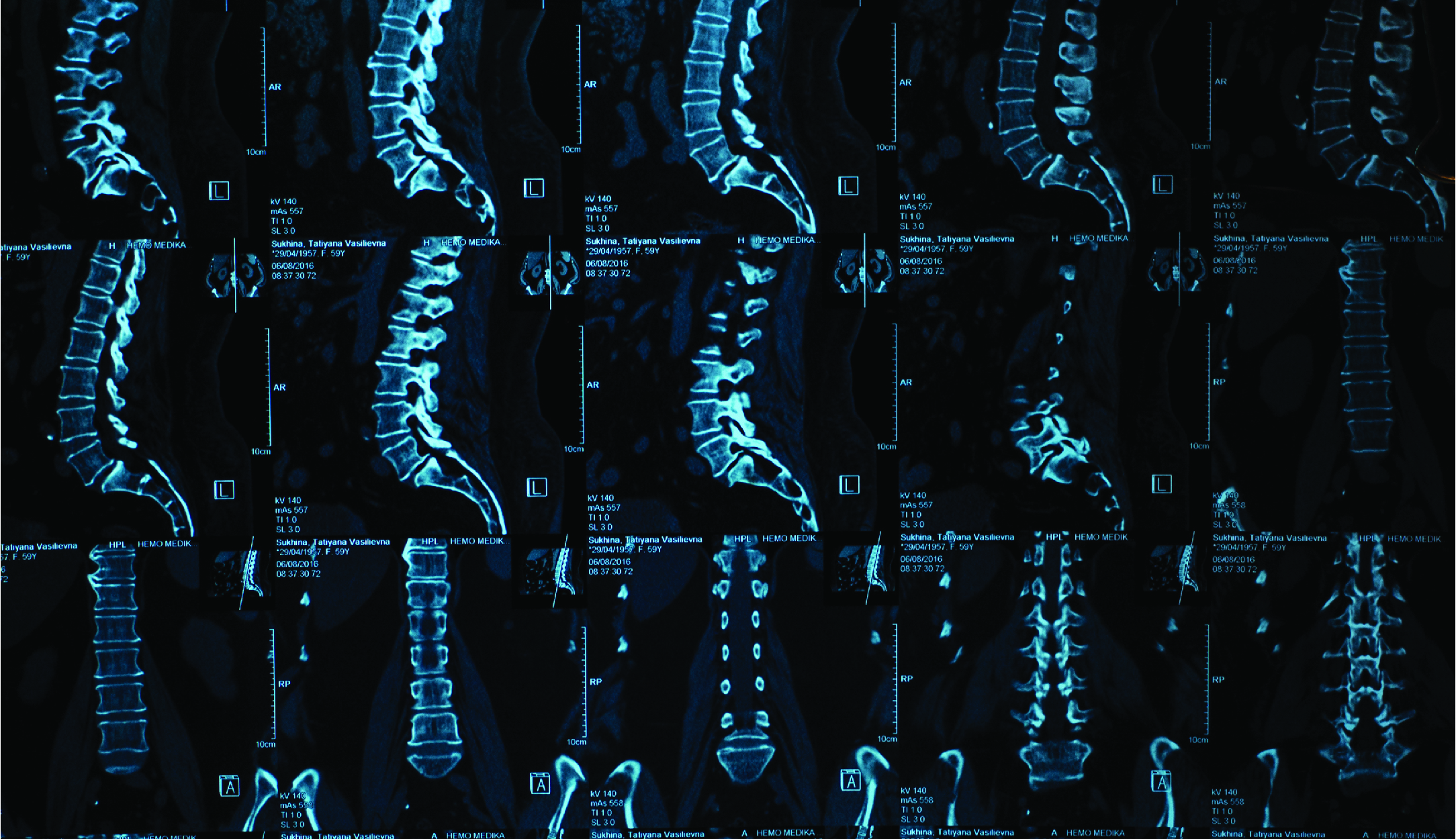 Scan of human spine