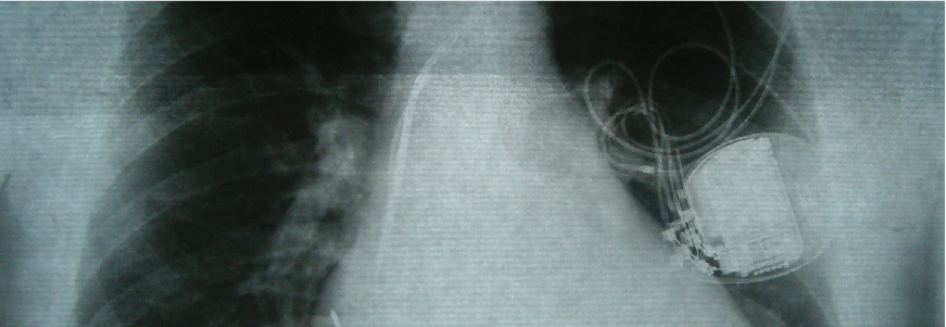 Xray of heart device in chest