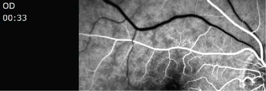 MRI of an eye stroke