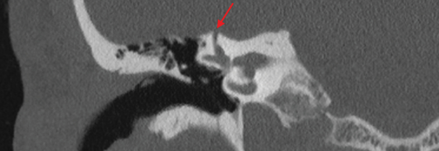 Corneal CT scan showing dehiscent semicircular canal