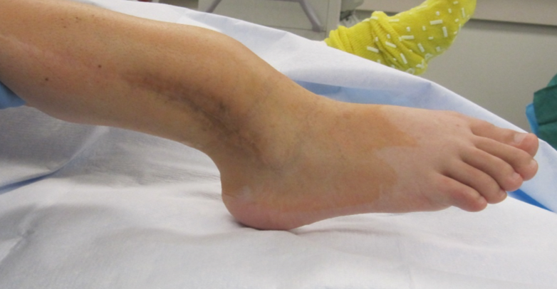 Patient's tibial deformity