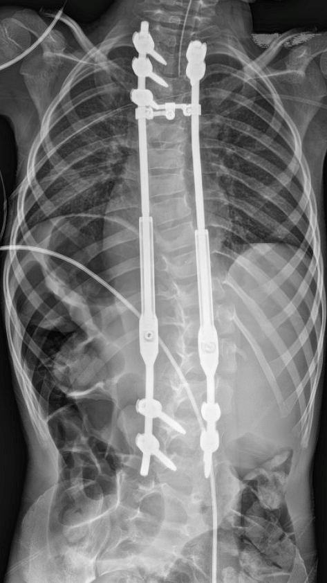 Early-onset scoliosis patient spine radiograph after surgery showing MARVEL nonmagnetic growing rods 