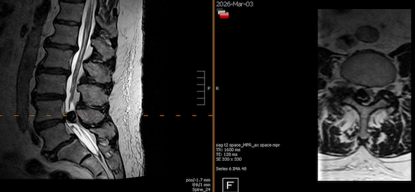 Imaging showing successful cyst removal