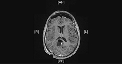 Postoperative MRI