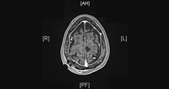 Postoperative MRI