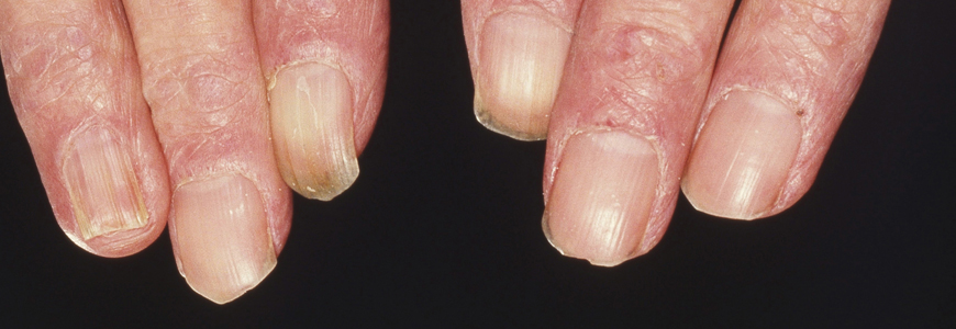 A rash associated with dermatomyositis 