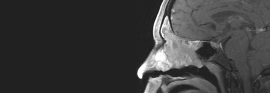 MRI of nasel passage