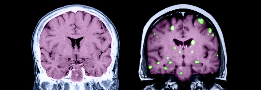 CT scan showing brain metastasis