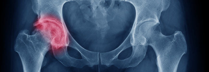 xray of hip joint