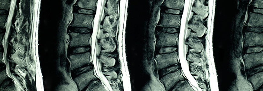 Scan of lumbar spine