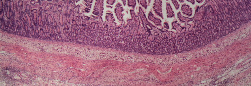 Microscope photo of a human large intestine section with inflammation