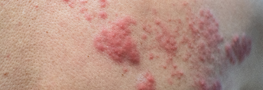 Shingles herpes zoster