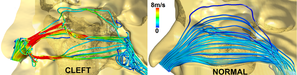 Function Follows Form for Treating Unilateral Cleft Lip Nasal Deformity