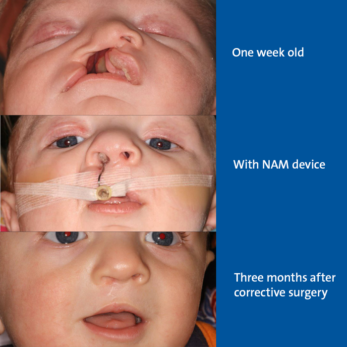 Patient with cleft palet before during and after NAM