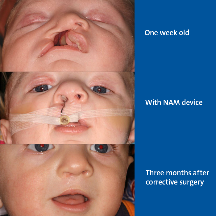 cleft lip and palate before and after