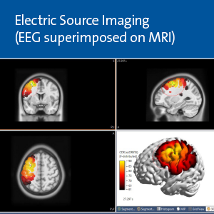 EEG superimposed on MRI