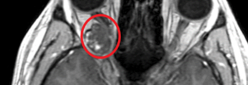 Scan showing cavernoma in patient's brain