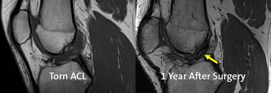 MRI of torn ACL and BEAR procedure one year out