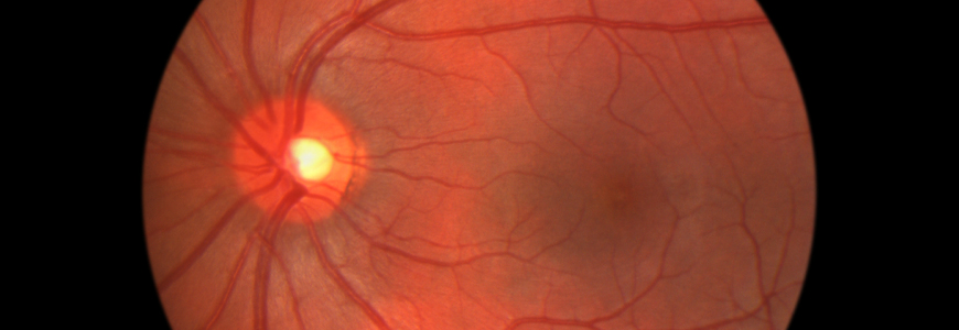 Veins in eye