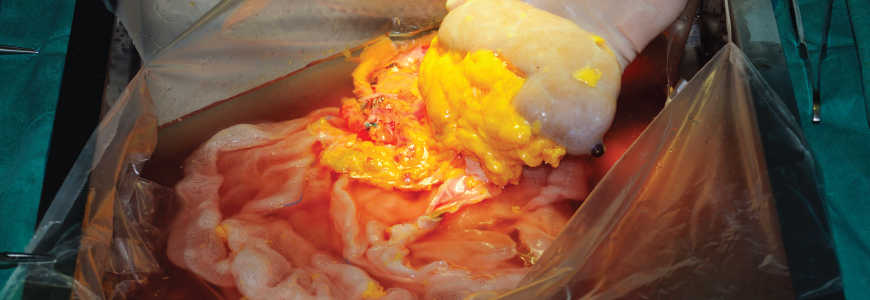 Kidney transplant