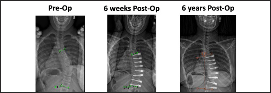 Xray of patient pre-op and post-op