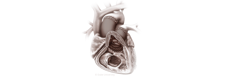 Illustration of Domino Partial Heart Transplant