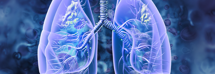 Lung cancer 3d illustration