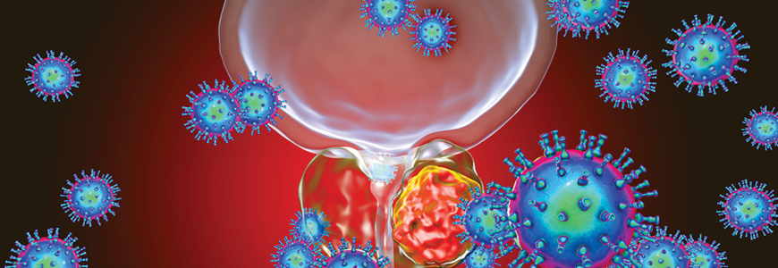 Conceptual image for viral ethiology of prostate cancer