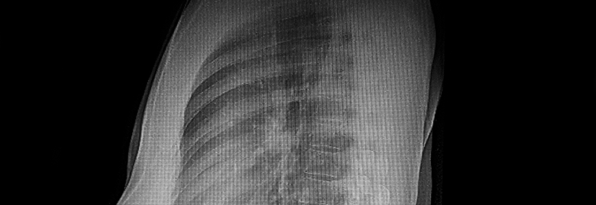 Lateral CXR showing pectus excavatum