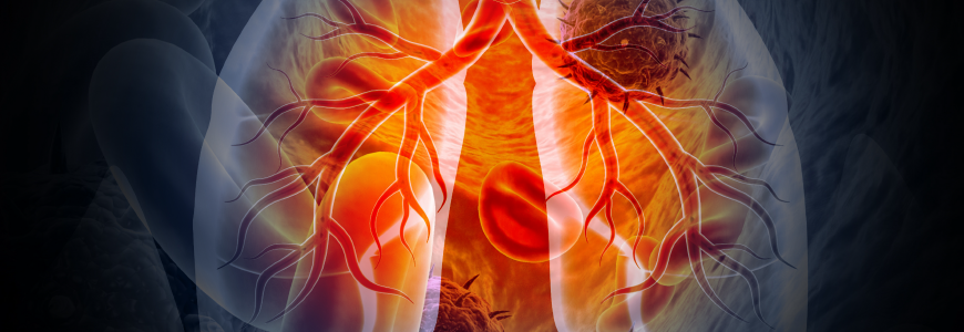 Medical Illustration showing lung cancer or bronchial carcinoma on medical background