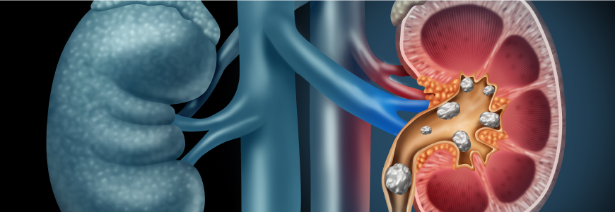 Human Kidney stones medical concept as an organ with painful crystaline mineral formations as a medicine symbol with a cross section with 3D illustration elements.