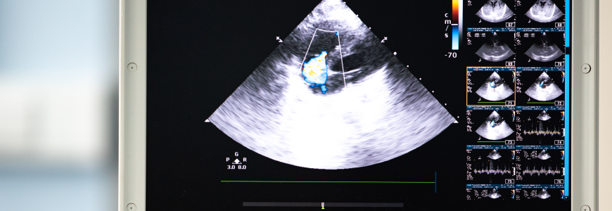 A screen of an ultrasound device with a heart scan and tricuspid regurgitation shown