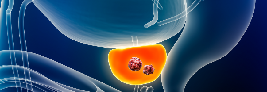 Prostate cancer with organs and tumor or cancerous cells 3D rendering illustration