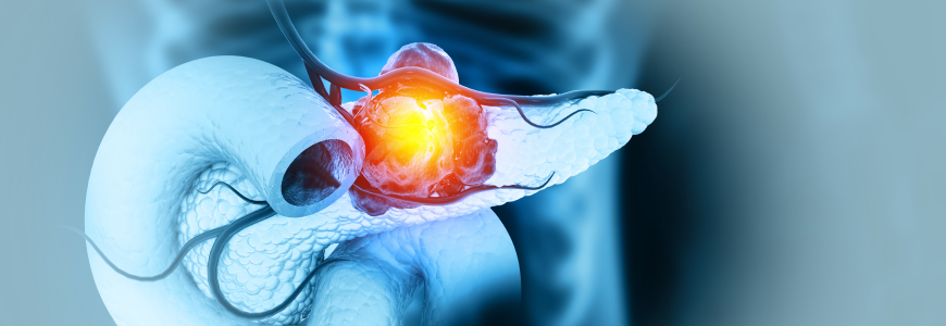 Pancreatic cancer is cancer that forms in the cells of the pancreas.