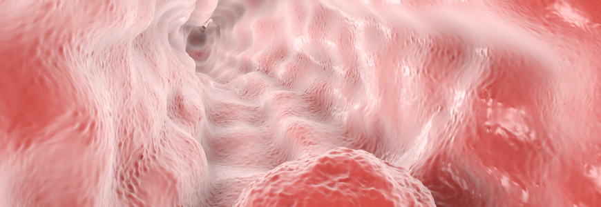 Oesophageal cancer, computer illustration
