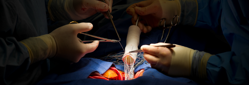Heart Surgery Aortic Valve and Ascending Aorta Replacement