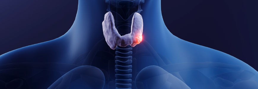 Thyroid gland cancer, 3d illustration
