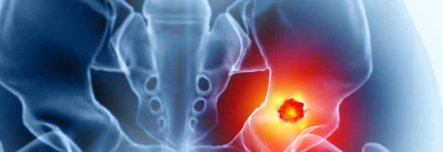 Hip bone cancer or tumor, one side pain. 3d illustration