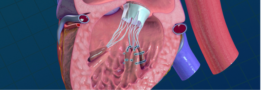 Illustration of Living Mitral Valve Replacement